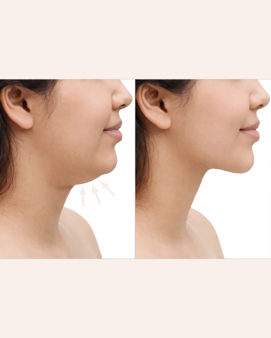Double Chin Reduction at Cinch Clinics